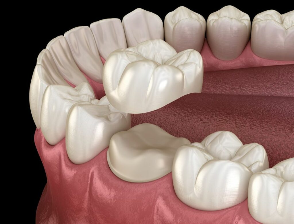 What Are the Pros and Cons of Dental Crowns?