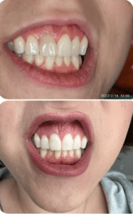  Women Single Tooth Whitening After Root Canal