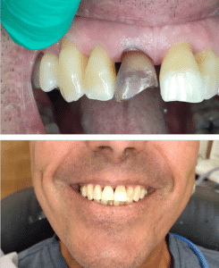 Men Single Tooth Whitening After Root Canal