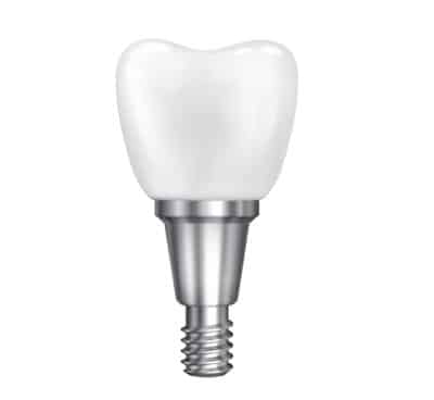 Dental implant