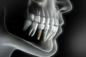 What-Are-The-Types-of-Dental-Implants