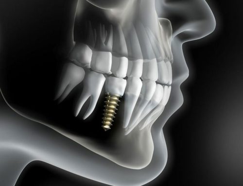 What Are The Types of Dental Implants?