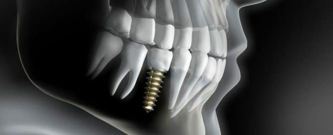 What-Are-The-Types-of-Dental-Implants