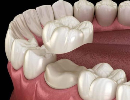 What Are the Pros and Cons of Dental Crowns?