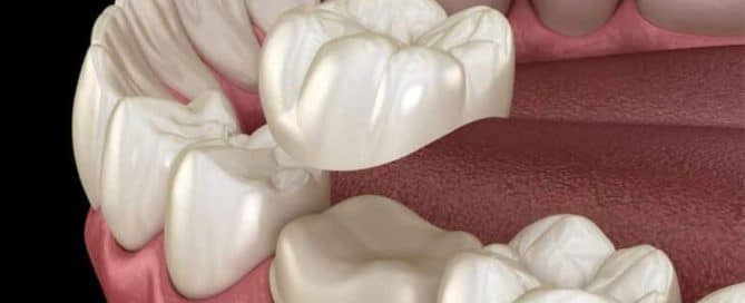 What-Are-the-Pros-and-Cons-of-Dental-Crowns
