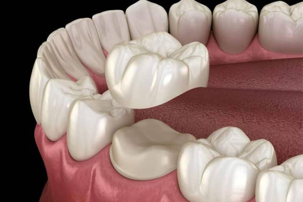 What-Are-the-Pros-and-Cons-of-Dental-Crowns