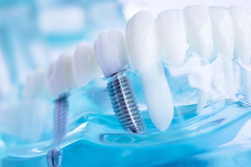 What Are The Benefits Of Dental Implants