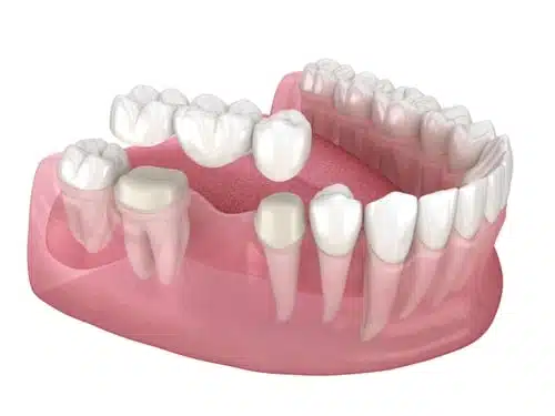 who-is-a-candidate-for-a-dental-bridge Who Is A Candidate For A Dental Bridge