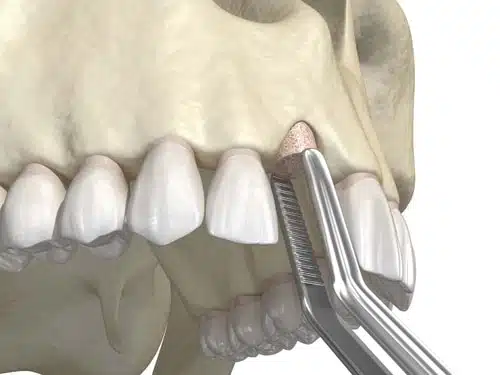 Who Is A Candidate For Bone Grafting