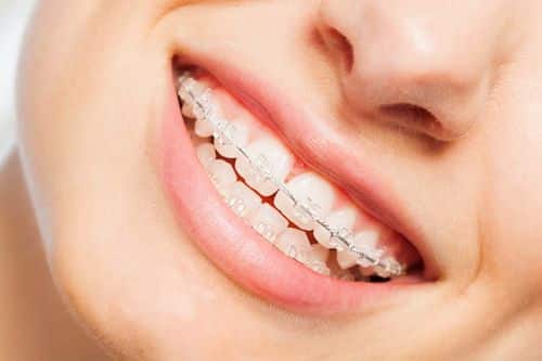 Who Is A Candidate For Braces