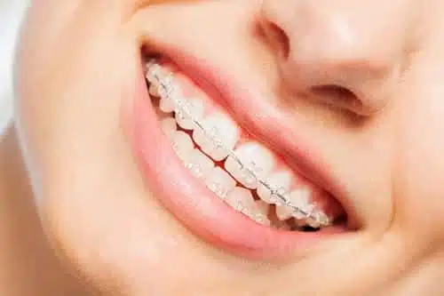 who-is-a-candidate-for-braces Who Is A Candidate For Braces