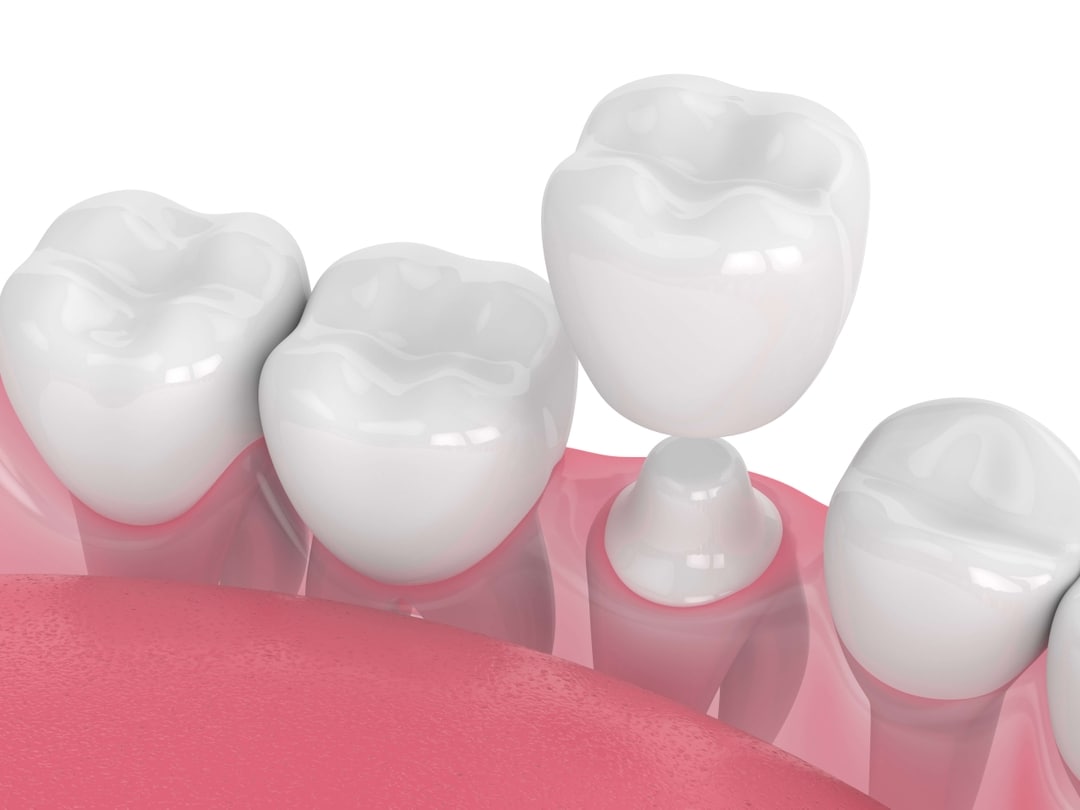Who Is A Candidate For Dental Crowns