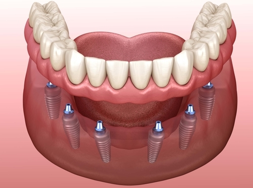 Who Is A Candidate For Implant-Supported Dentures
