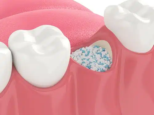 3d,render,of,dental,bone,grafting,with,dental,bone,biomaterial