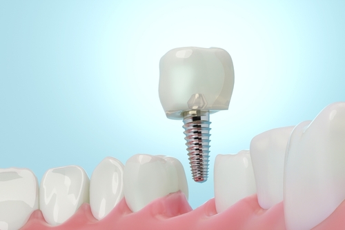 molar,teeth,implant,with,blue,science,background.,3d,rendering.