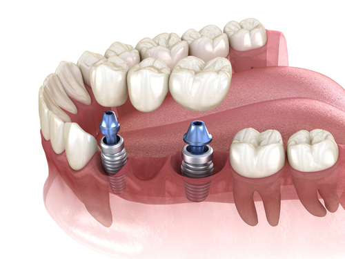 dental,bridge,supported,by,implants.,medically,accurate,3d,illustration,of