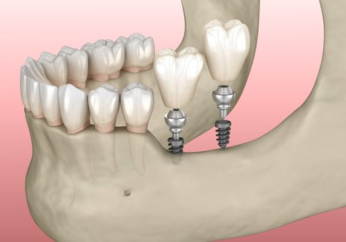 implantation,with,mini,implants,in,to,recessed,jaw,bone:,medically