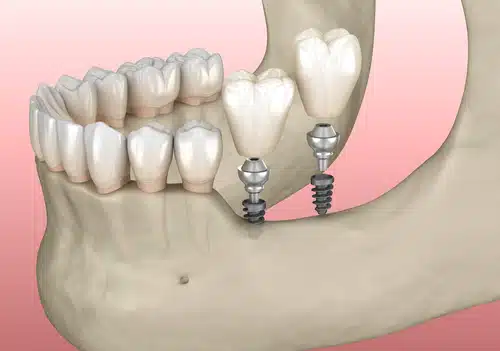 implantation,with,mini,implants,in,to,recessed,jaw,bone:,medically