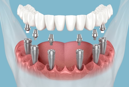 mandibular,prosthesis,with,gum,all,on,6,system,supported,by