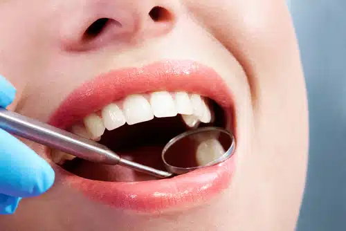 close up,of,open,mouth,during,oral,checkup,at,the,dentist