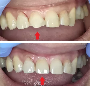  Men Single Tooth Whitening After Root Canal