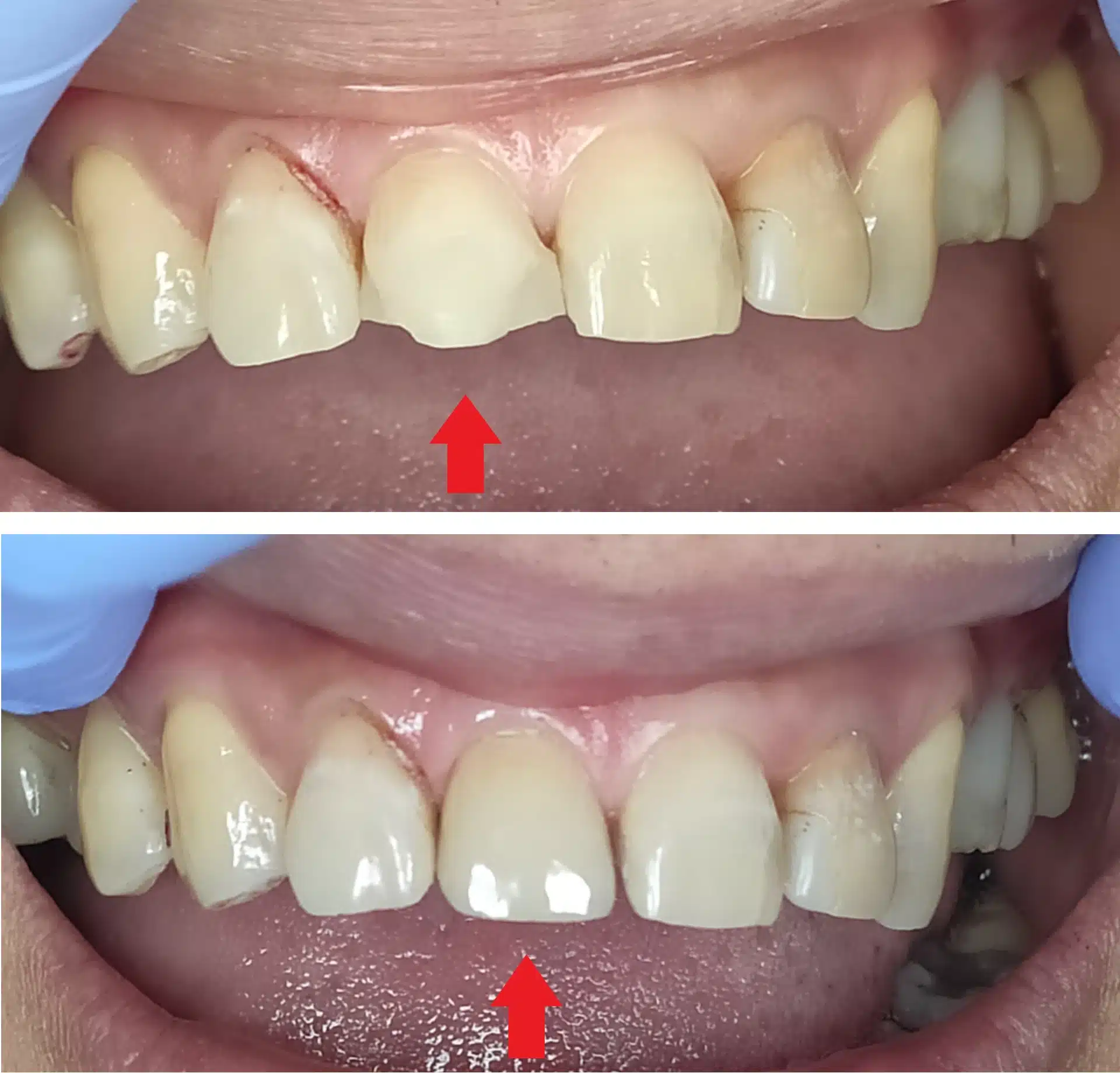 composite bonding before after