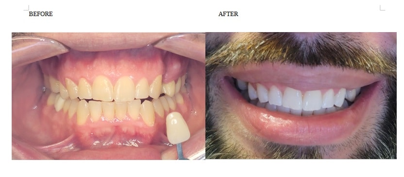 Dentures After