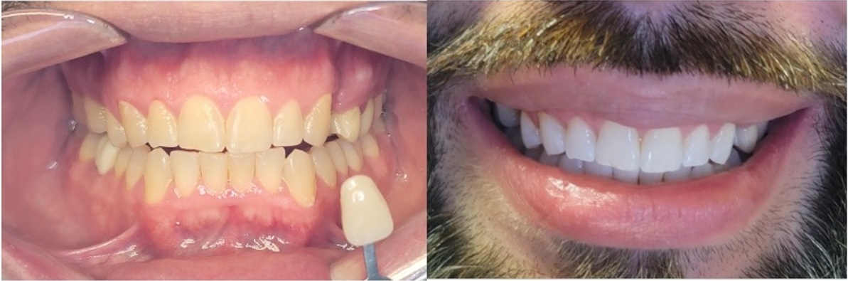 whitening picture Teeth whitening before and after photos